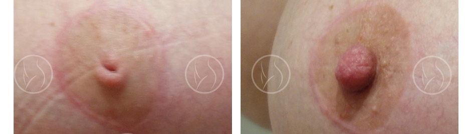 Photo avant / après de chirurgie des mamelons invaginés Photo avant / après de chirurgie des mamelons invaginés