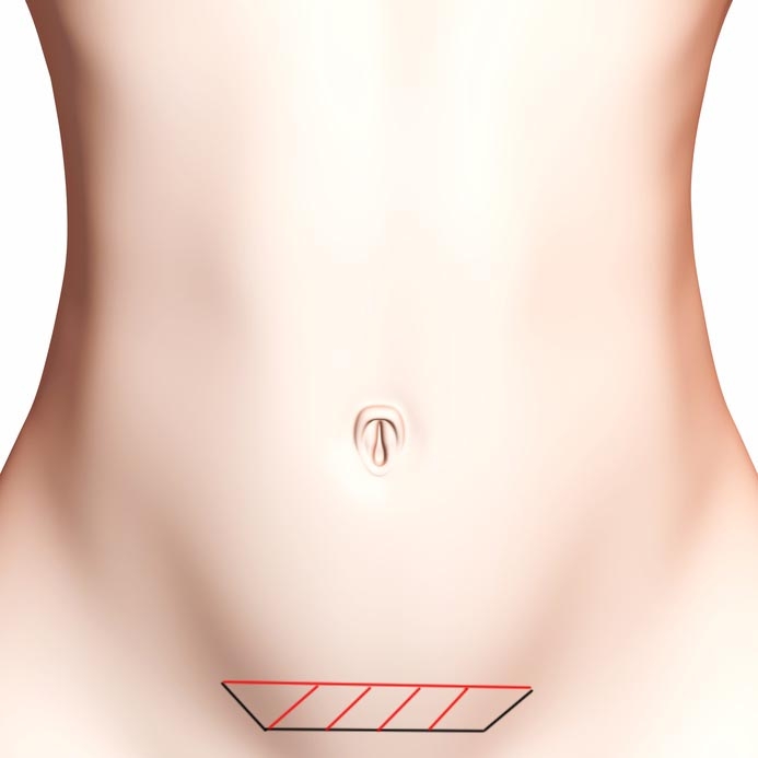 Schéma de la surface de peau retirée lors d'un mini lift abdominal Schéma de la surface de peau retirée lors d'un mini lift abdominal