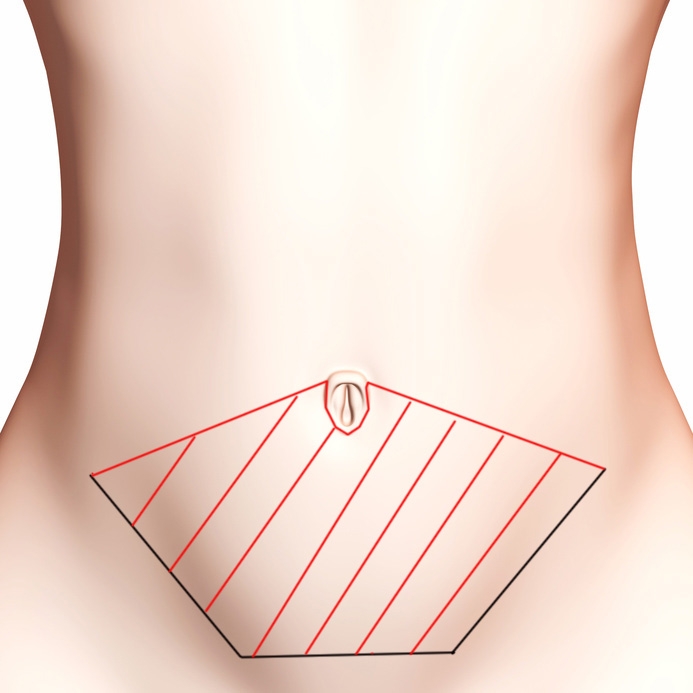 Schéma de la surface de peau retirée lors d'une abdominoplastie Schéma de la surface de peau retirée lors d'une abdominoplastie