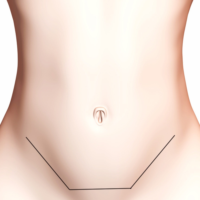 Schéma de la taille d'une incision pour une abdominoplastie Schéma de la taille d'une incision pour une abdominoplastie