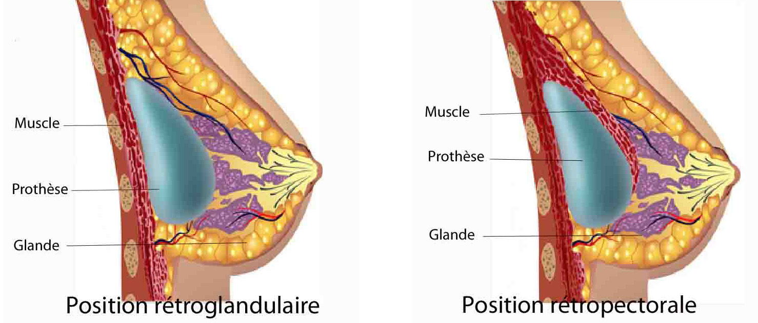 Le positionnement des prothèses devant ou derrière le muscle pour l'augmentation mammaire