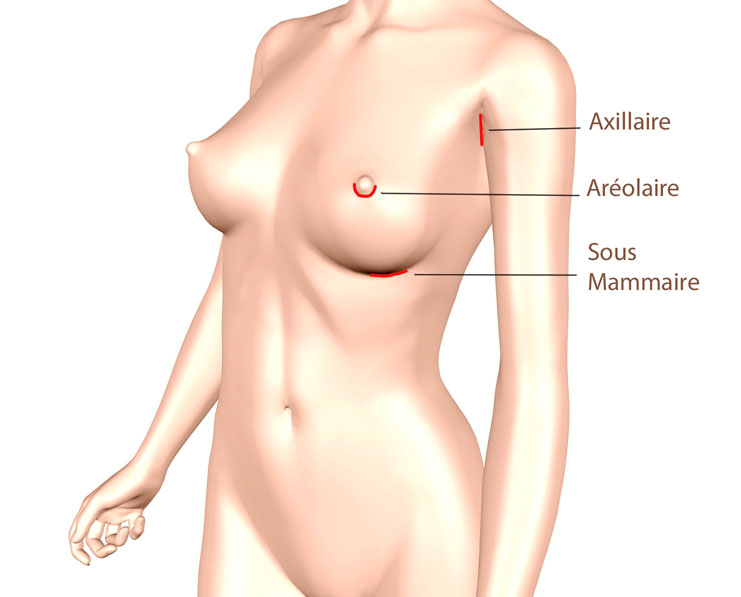Les voies d'abord pour la pose de prothèses mammaires