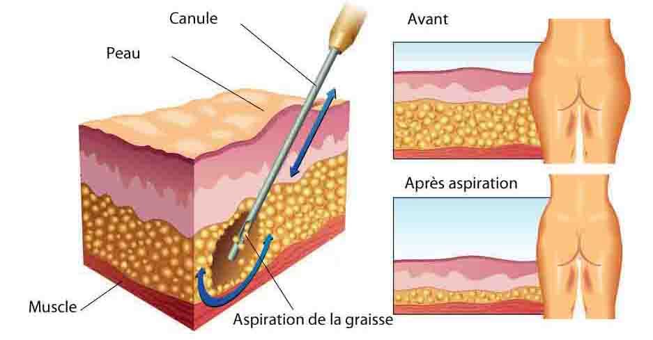 Principe de la liposuccion