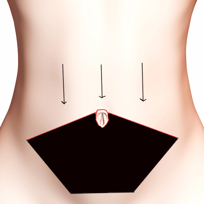 Schéma de la remise en tension de la peau vers le bas pour une abdominoplastie