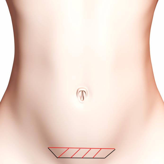 Schéma de la surface de peau retirée lors d'un mini lift abdominal