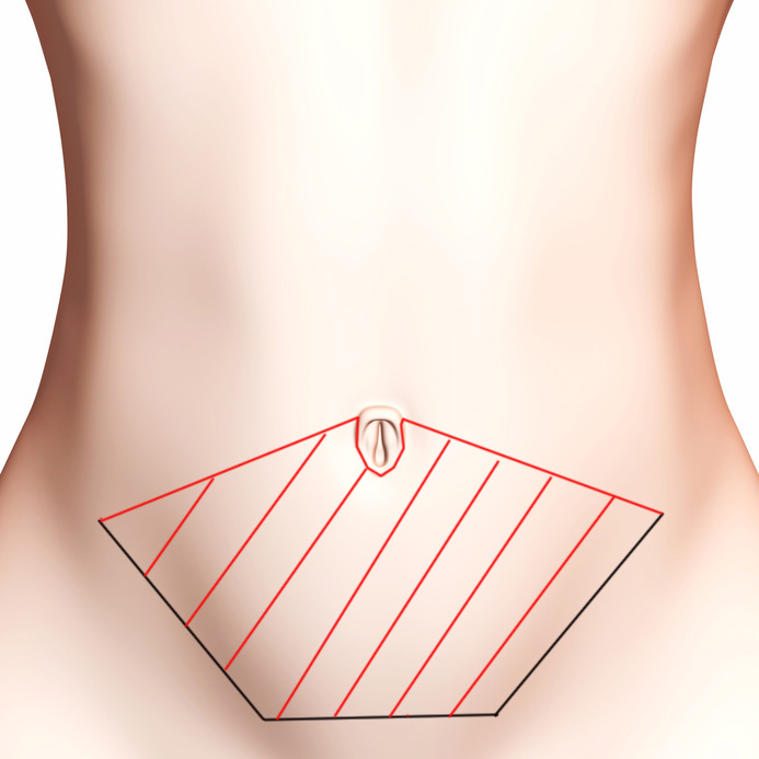 Schéma de la surface de peau retirée lors d'une abdominoplastie