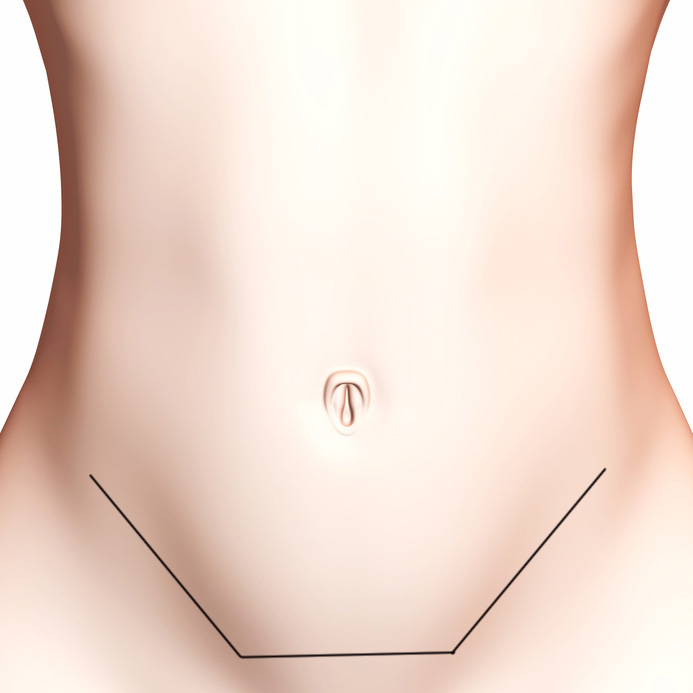 Schéma de la taille d'une incision pour une abdominoplastie