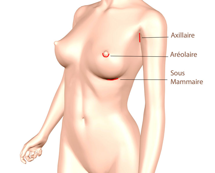 Schéma position des implants mammaires – augmentation mammaire Bordeaux