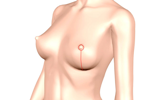 Shéma de la cicatrice verticale pour une réduction mammaire