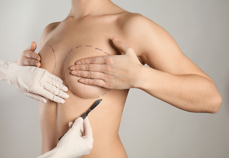 Augmentation mammaire composite à Bordeaux et Libourne - Définition