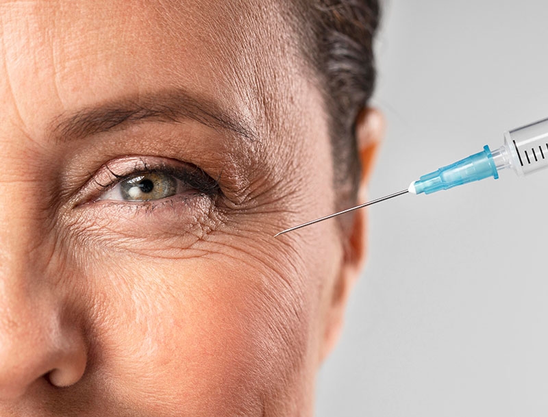 Corriger les sillons nasogéniens en injectant la pommette !
