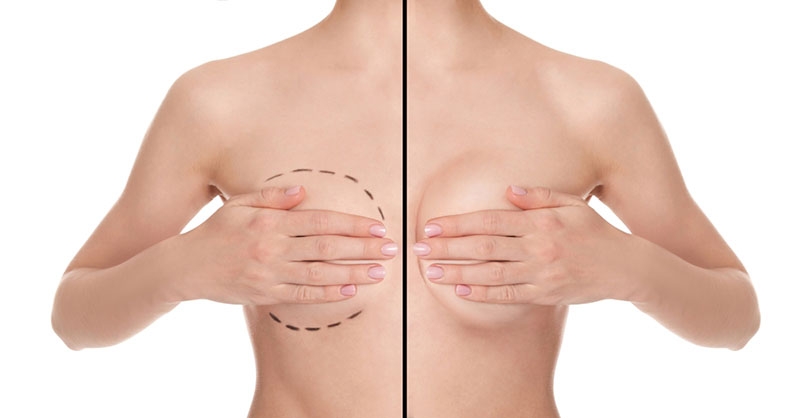 Implants mammaires ou lifting des seins à Bordeaux : Quelle différence ?