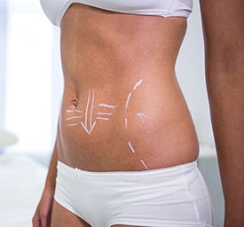 L’abdominoplastie : la plastie abdominale pour un ventre plat