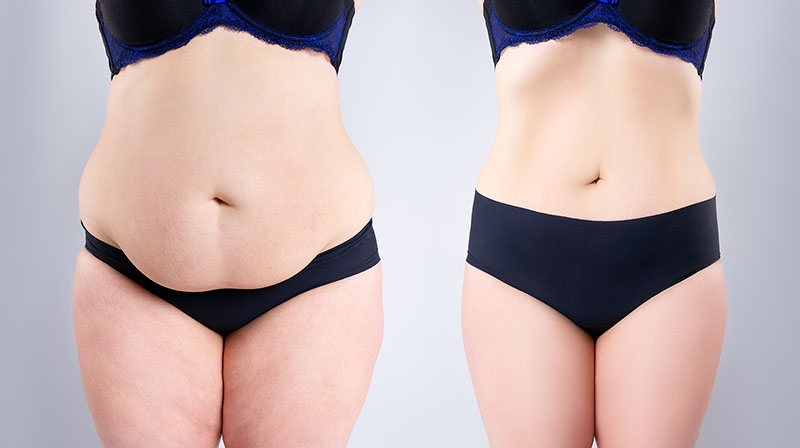 Ventre : liposuccion ou plastie abdominale ?
