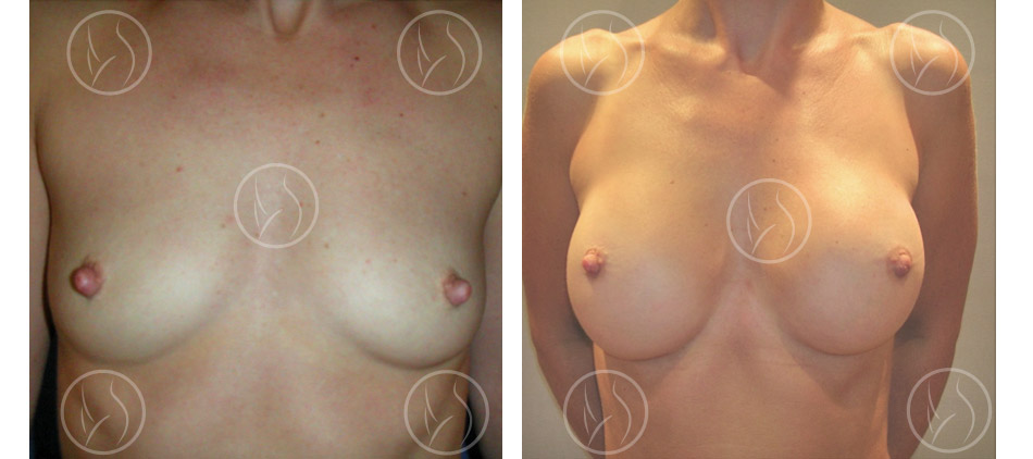 Cas n°1 : photo avant / après d'augmentation mammaire par prothèses vue de face