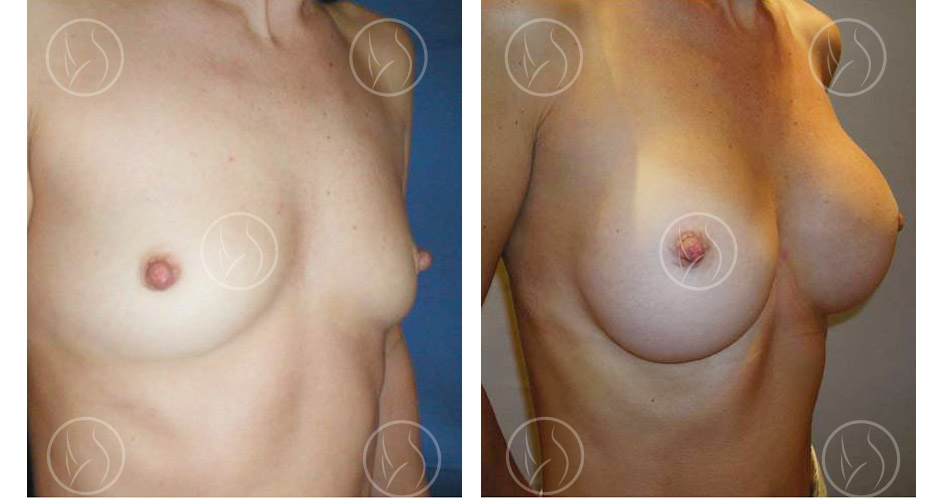 Cas n°1 : photo avant / après d'augmentation mammaire par prothèses vue de trois quart