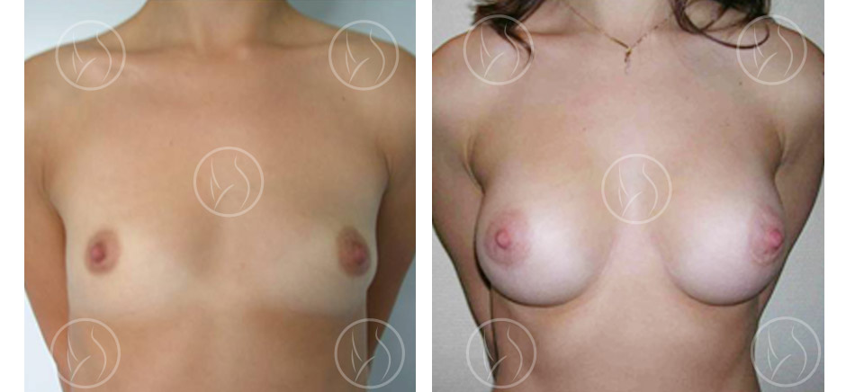 Cas n°3 : augmentation mammaire par prothèses vue de face
