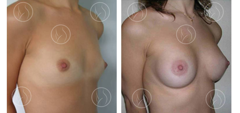 Cas n°3 : augmentation mammaire par prothèses vue de trois quart