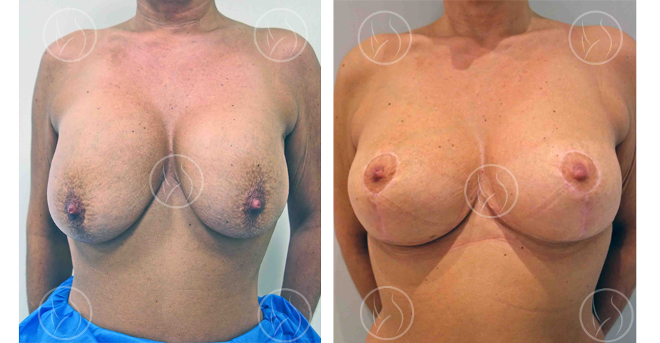 Changement de prothèses mammaire avant / après (vue de face)
