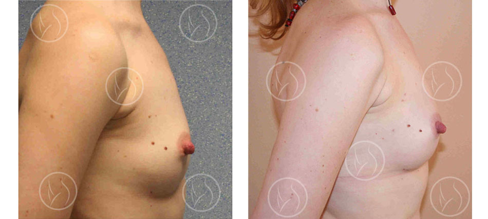 Lipofilling des seins avec augmentation d'un demi bonnet avant et après (vue de profil)