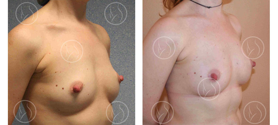 Lipofilling des seins avec augmentation d'un demi bonnet avant et après (vue de trois quart)