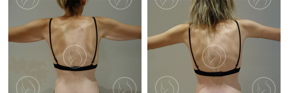 Photo avant / après de lifting des bras vue de dos