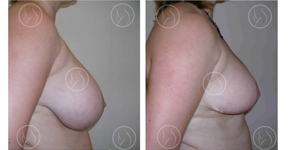 Photo avant / après de réduction mammaire
